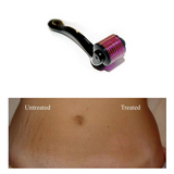 Derma Roller for Skin Care-Beauty-Prime4Choice.com-Prime4Choice.com